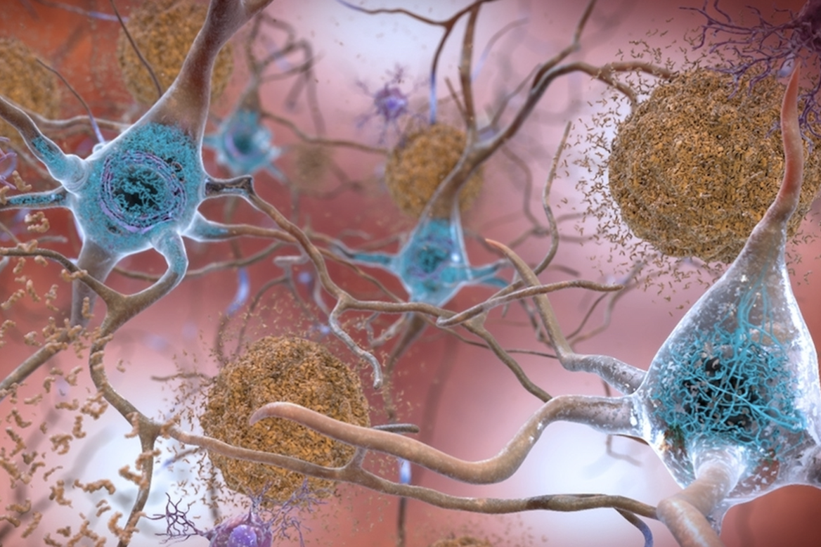 New Understanding of Alzheimer's Could Transform Treatment Approach