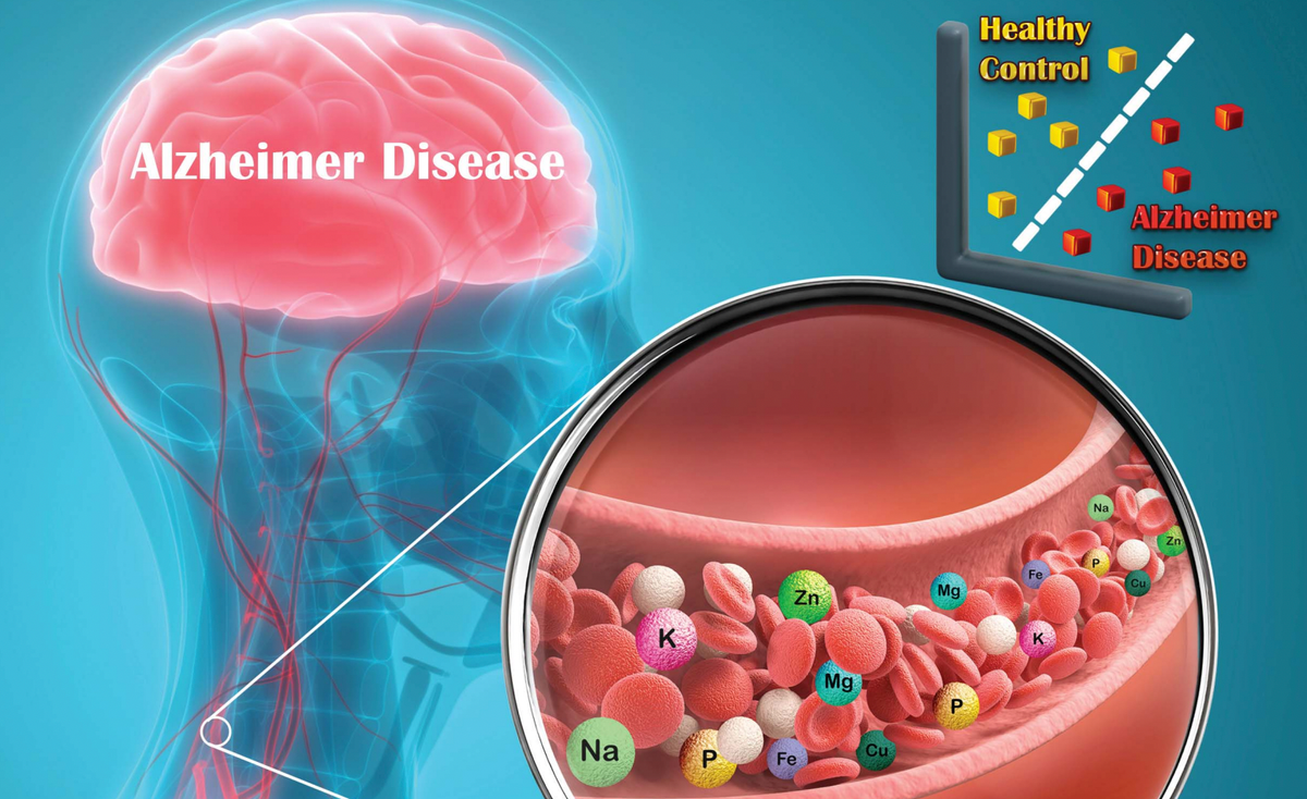 Unveiling the Connections: Blood Plasma, Gut Health, and Alzheimer's